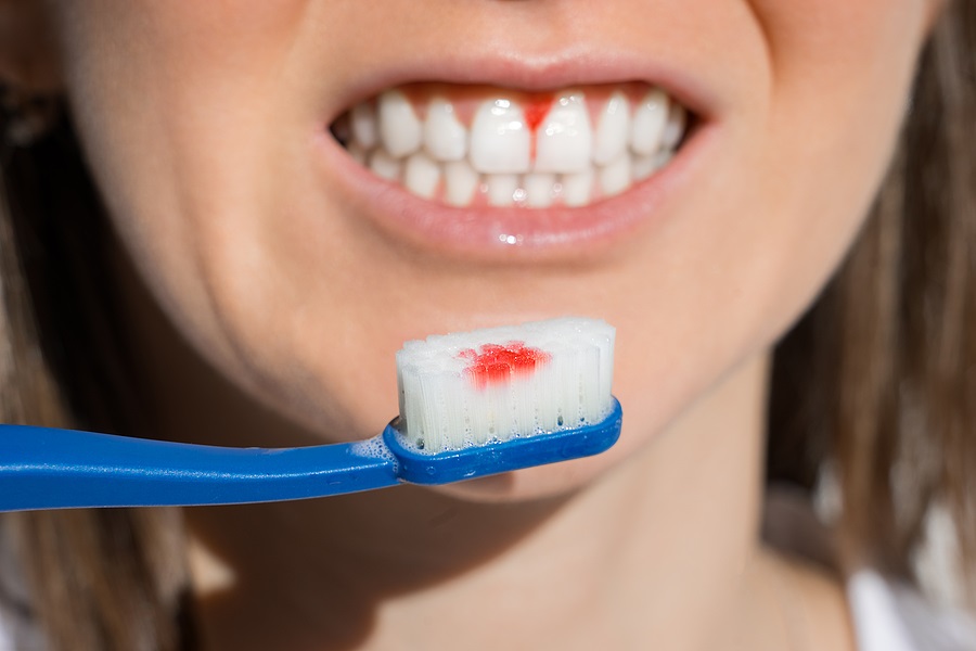 Periodontal Treatment Periodontal Treatment