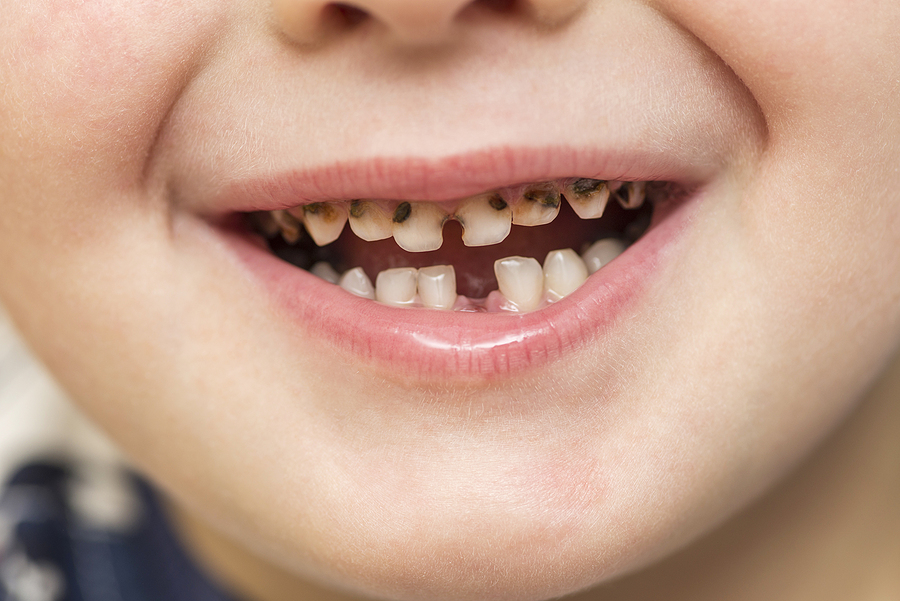 When Should Children Have Their First Dental Visit? When Should Children Have Their First Dental Visit?