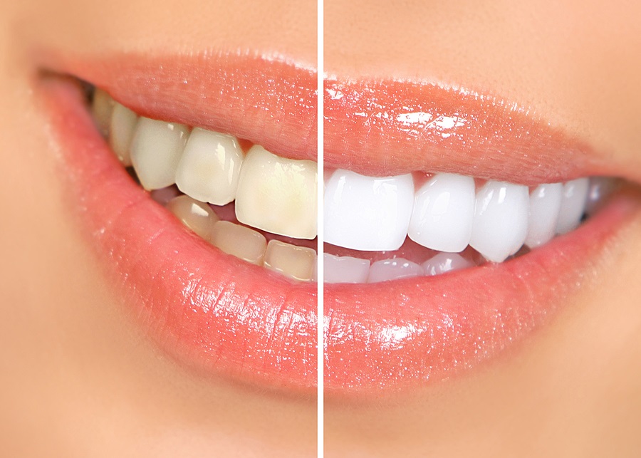 Empress® Restorations Empress® Restorations