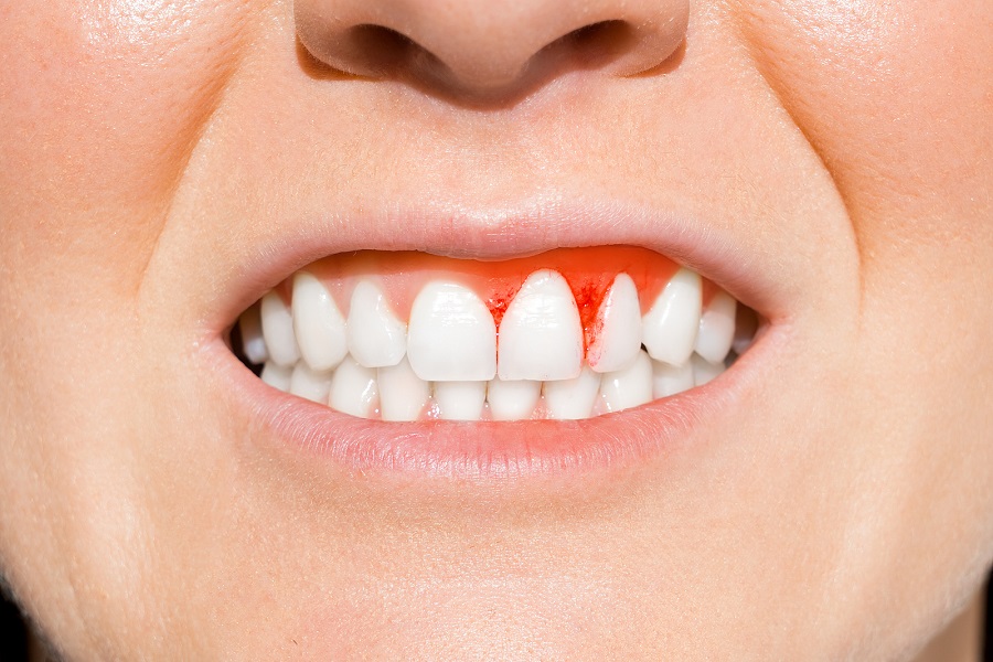 Signs & Symptoms of Periodontal Disease Signs & Symptoms of Periodontal Disease