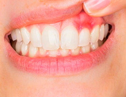 Gum Disease Gum Disease